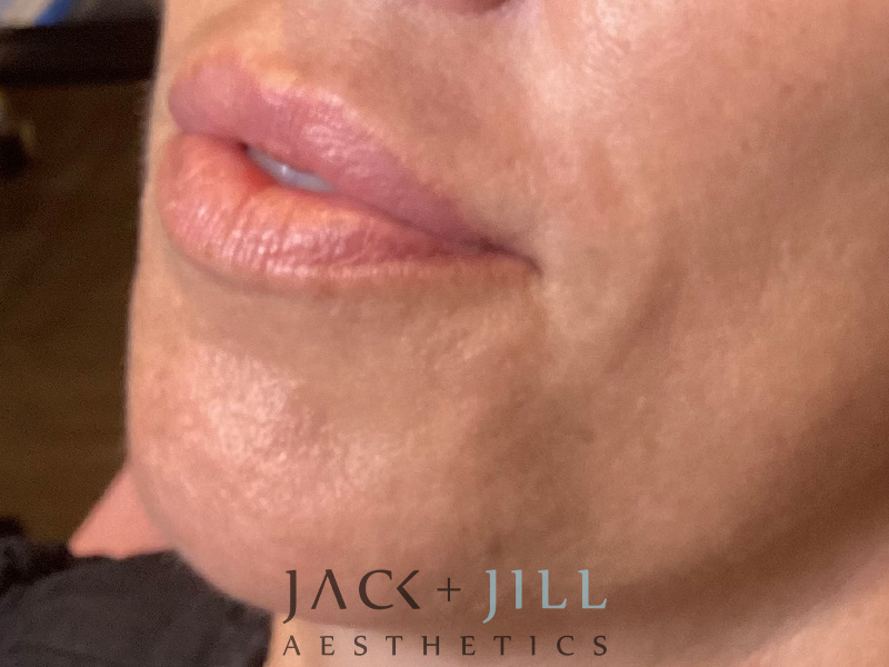 Injectable Fillers And Neurotoxins Before and After | Jack + Jill Aesthetics