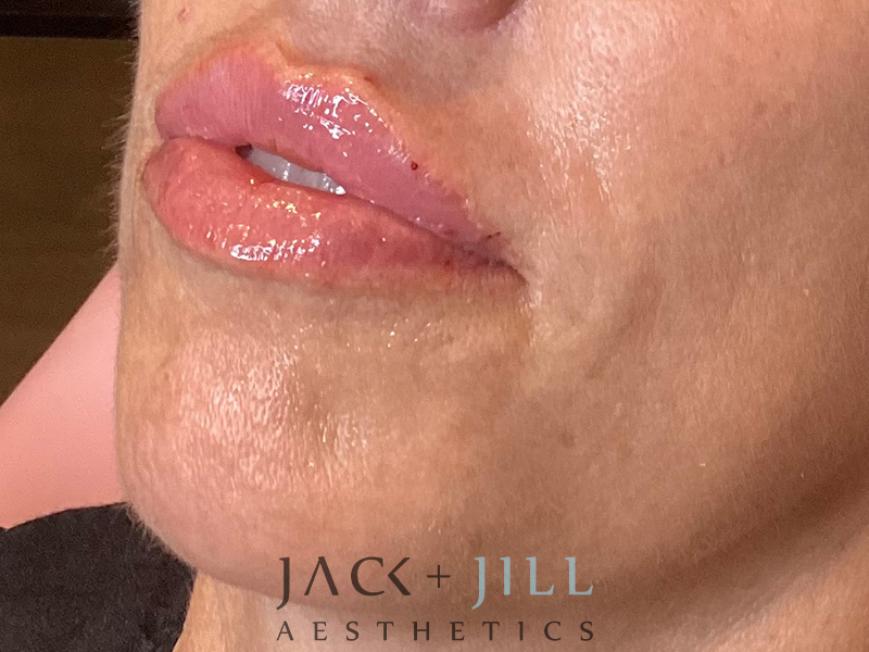 Injectable Fillers And Neurotoxins Before and After | Jack + Jill Aesthetics
