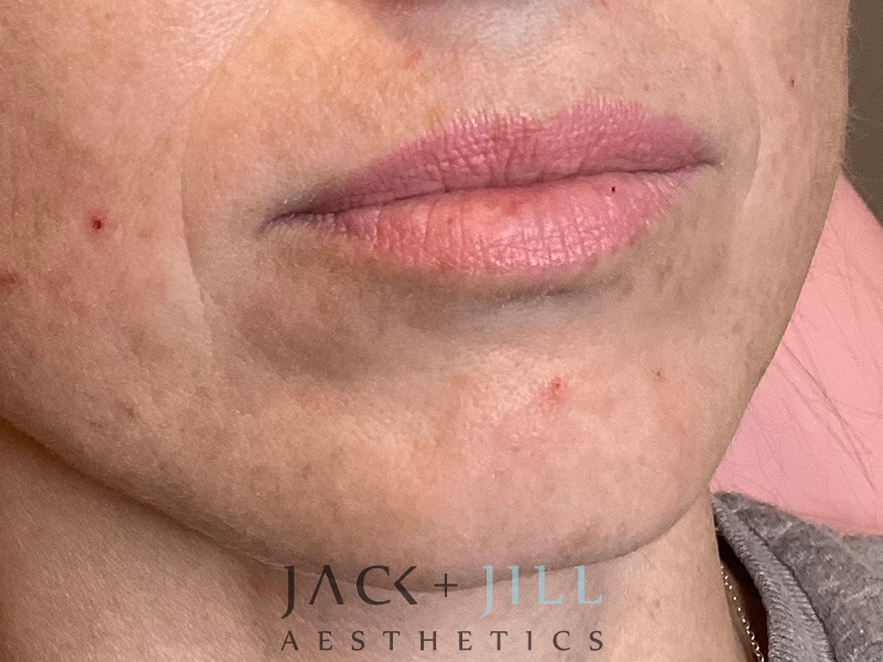Injectable Fillers And Neurotoxins Before and After | Jack + Jill Aesthetics