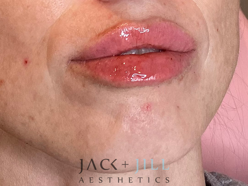 Injectable Fillers And Neurotoxins Before and After | Jack + Jill Aesthetics