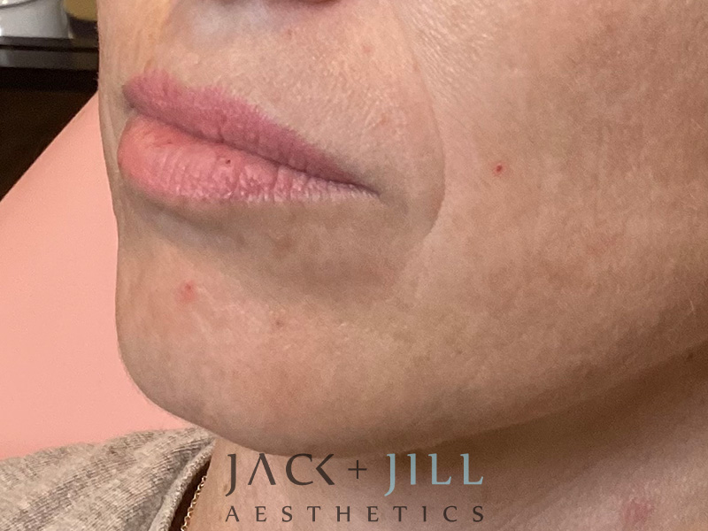 Injectable Fillers And Neurotoxins Before and After | Jack + Jill Aesthetics