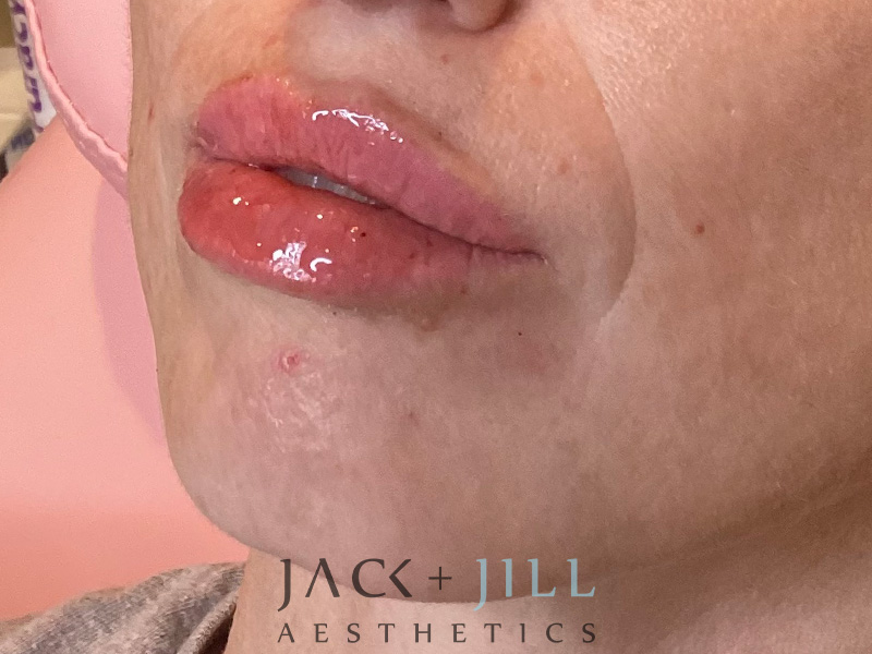 Injectable Fillers And Neurotoxins Before and After | Jack + Jill Aesthetics
