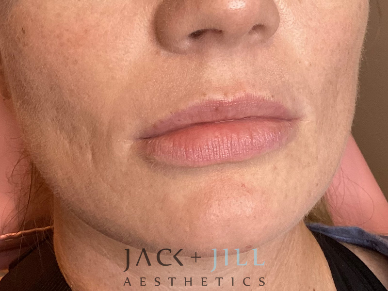 Injectable Fillers And Neurotoxins Before and After | Jack + Jill Aesthetics