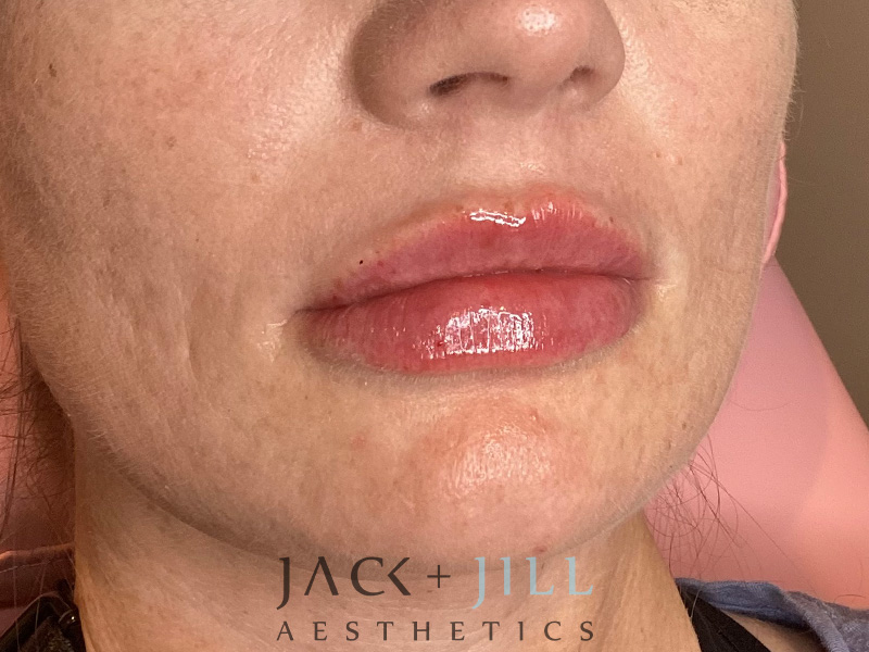 Injectable Fillers And Neurotoxins Before and After | Jack + Jill Aesthetics