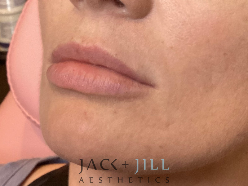 Injectable Fillers And Neurotoxins Before and After | Jack + Jill Aesthetics