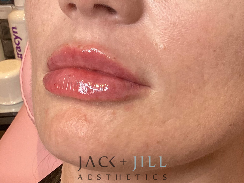 Injectable Fillers And Neurotoxins Before and After | Jack + Jill Aesthetics