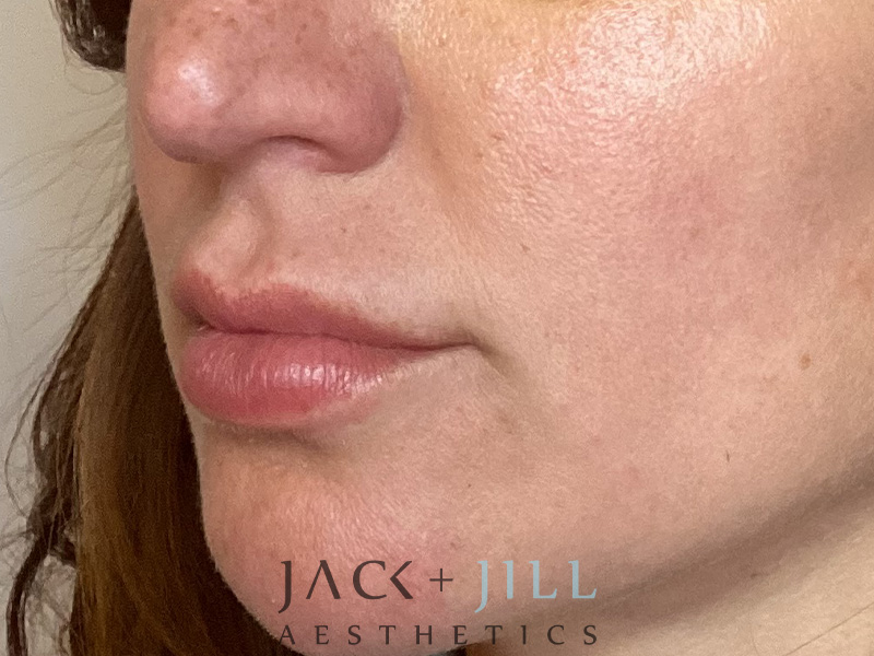 Injectable Fillers And Neurotoxins Before and After | Jack + Jill Aesthetics