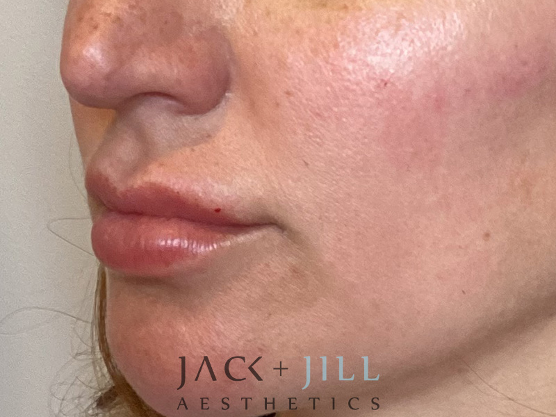 Injectable Fillers And Neurotoxins Before and After | Jack + Jill Aesthetics