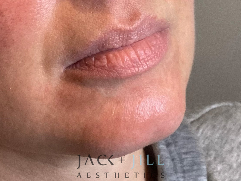 Injectable Fillers And Neurotoxins Before and After | Jack + Jill Aesthetics
