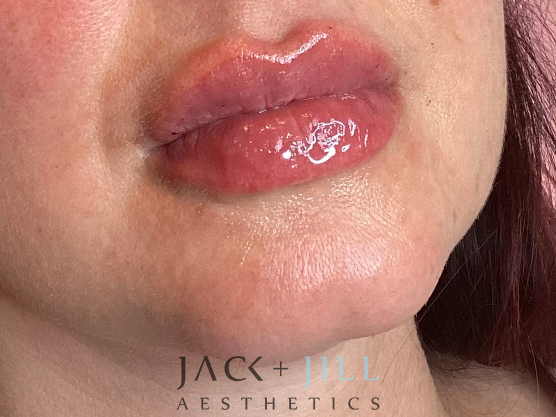Injectable Fillers And Neurotoxins Before and After | Jack + Jill Aesthetics