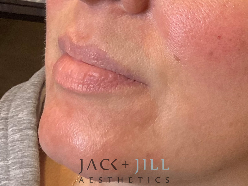 Injectable Fillers And Neurotoxins Before and After | Jack + Jill Aesthetics