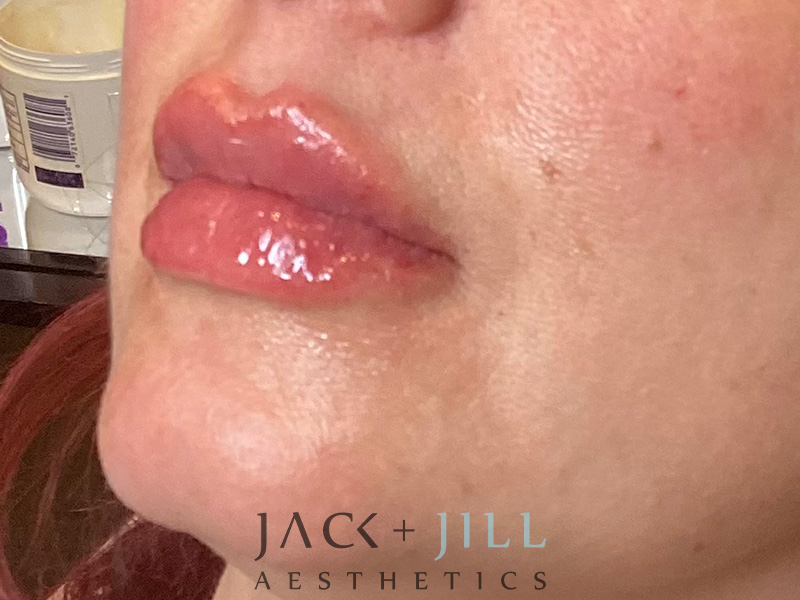 Injectable Fillers And Neurotoxins Before and After | Jack + Jill Aesthetics