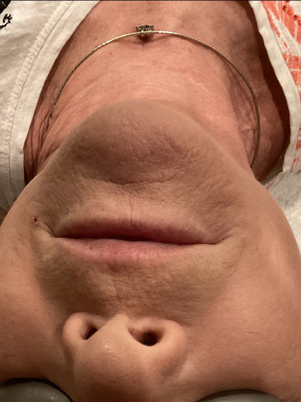 Laser Skin Rejuvenation Before and After | Jack + Jill Aesthetics