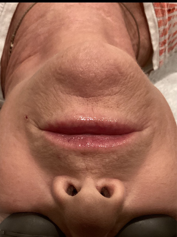 Laser Skin Rejuvenation Before and After | Jack + Jill Aesthetics