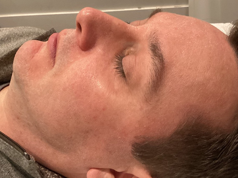 Laser Skin Rejuvenation Before and After | Jack + Jill Aesthetics