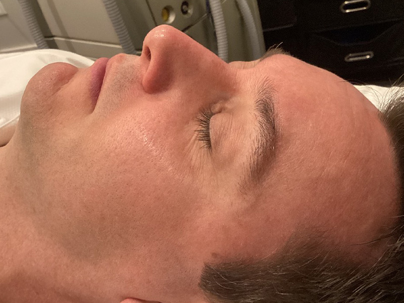 Laser Skin Rejuvenation Before and After | Jack + Jill Aesthetics
