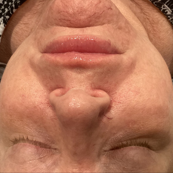 Laser Skin Rejuvenation Before and After | Jack + Jill Aesthetics