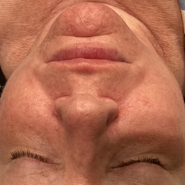 Laser Skin Rejuvenation Before and After | Jack + Jill Aesthetics