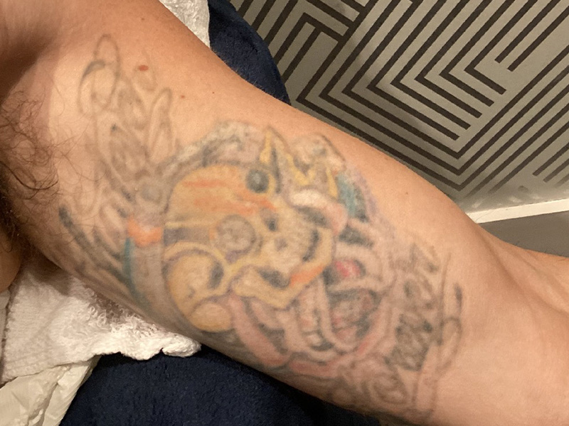 Laser Tattoo Removal Before and After | Jack + Jill Aesthetics