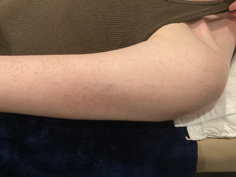 Laser Tattoo Removal Before and After | Jack + Jill Aesthetics