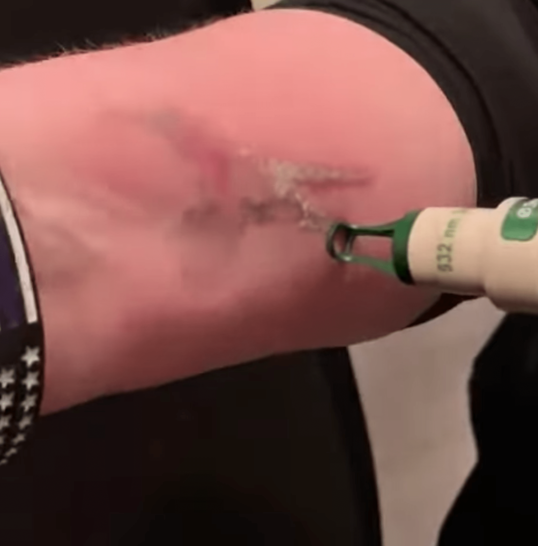 Treatment Video